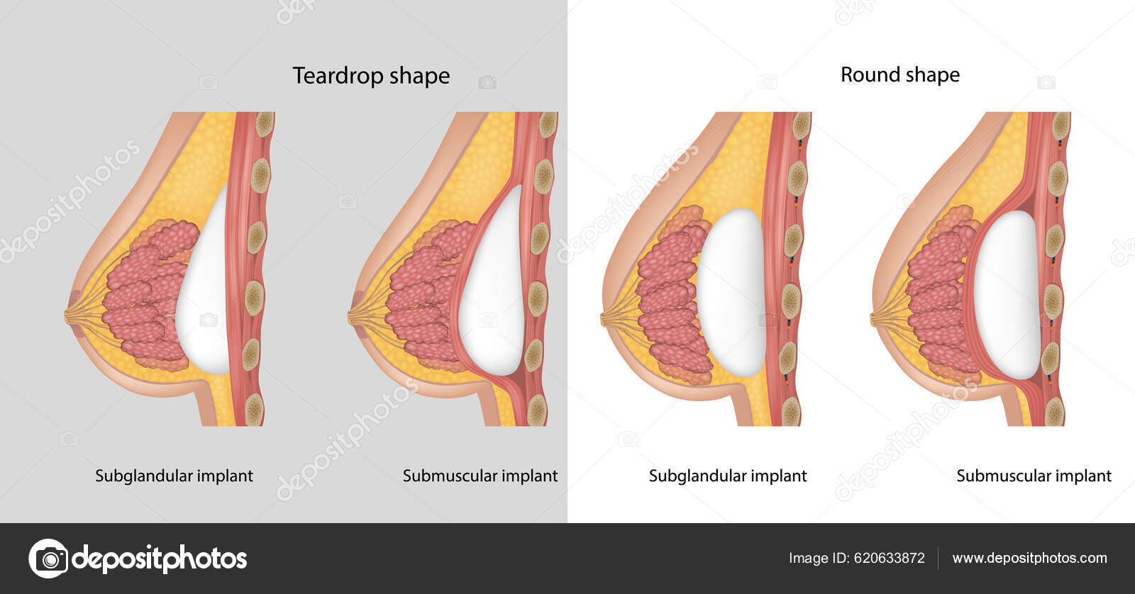 Subglandular Submuscular Breast Implants Breast Implant Shapes