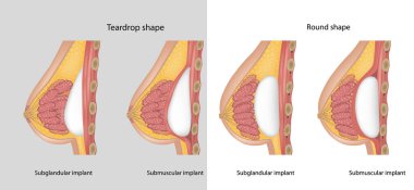 Subglandüler ve submusküler göğüs implantları. Göğüs implantı gözyaşı damlası şeklini ve yuvarlak şeklini alır. Göğüs implantı tipleri.