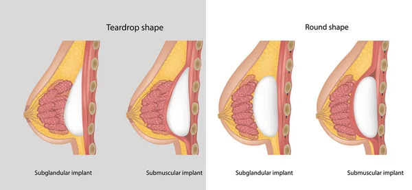 Subglandüler Submusküler Göğüs Implantları Göğüs Implantı Gözyaşı Damlası Şeklini Yuvarlak — Stok Vektör