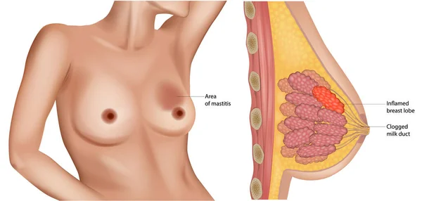 マスティティス 乳房の炎症を伴う乳腺の断面 不在形成 詰まったミルクダクト 炎症を起こした胸のローブ — ストックベクタ