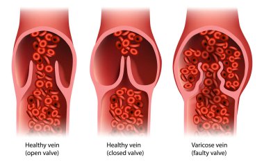 Chronic Venous Insufficiency or venous reflux.Venous Disease Varicose vein Faulty valve. Healthy vein Closed and open valve. clipart
