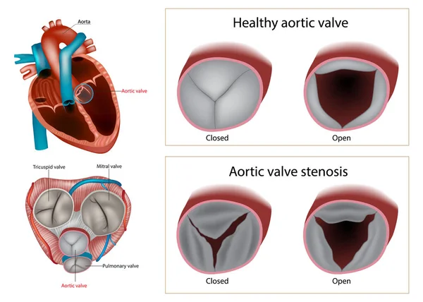 健康的主动脉瓣或主动脉瓣狭窄 心脏瓣膜疾病或瓣膜性心脏病的类型 解剖心脏 — 图库矢量图片