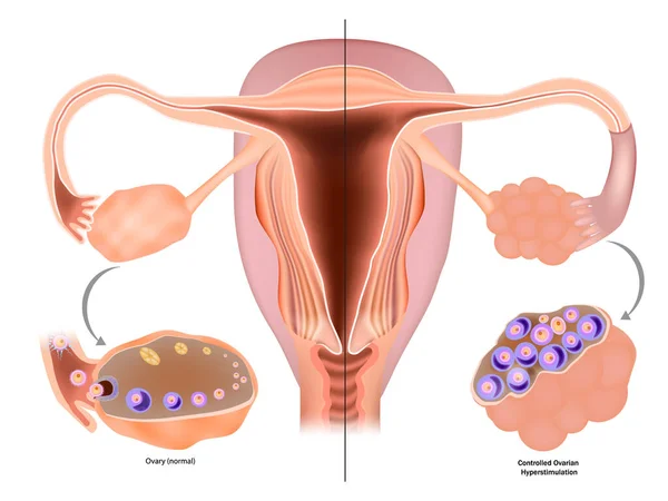 stock vector Controlled Ovarian Stimulation COS or Controlled ovarian hyperstimulation COH for IVF. Selecting the ideal protocol