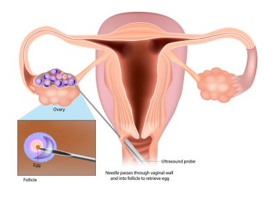 IVF Egg Retrieval technique. Egg retrieval procedure before in vitro fertilization. Follicle, Ovary. clipart