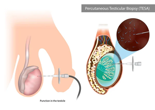 Percutanpercutaneous Testicular Biopsy Tesa Punction Testicle Surgical Sperm Retrieval Methods — Vector de stock
