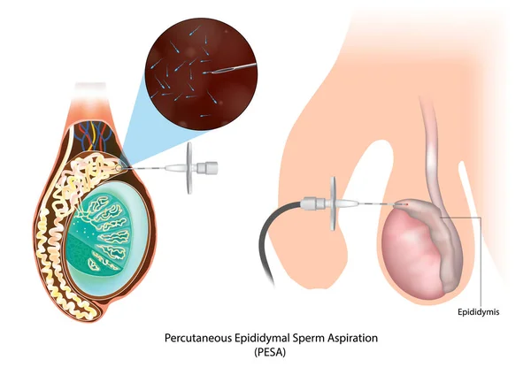 Perkutan Epididymal Spermieaspiration Pesa Testikelbiopsi Epididymis Azoospermi Spermiehämtningsteknik För Azoospermiska — Stock vektor