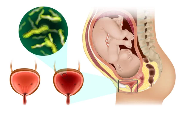 Ουρολοίμωξη Κατά Διάρκεια Της Εγκυμοσύνης Οξεία Και Διάμεση Κυστίτιδα Ουρολογία — Διανυσματικό Αρχείο