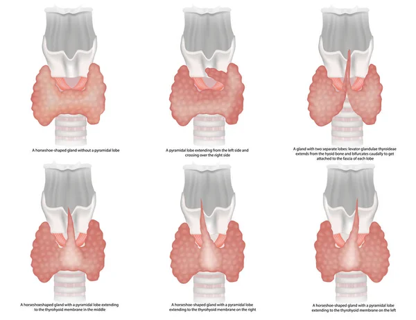 Ілюстрація Класифікації Форм Щитовидної Залози Анатомічні Варіації Типи Щитовидної Залози — стоковий вектор
