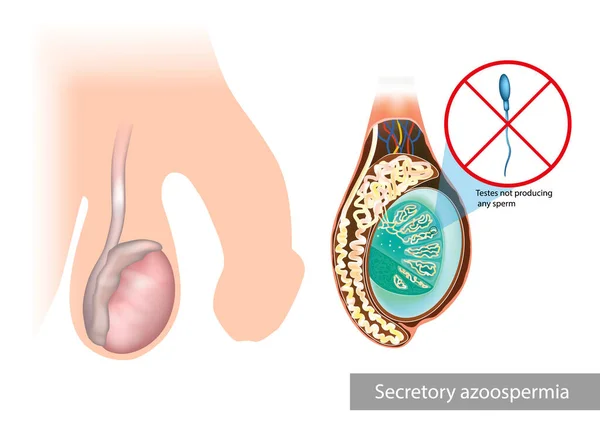 分泌性或非阻塞性精子 不产生精子 没有精子的生产 睾丸问题 — 图库矢量图片