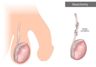Vazektomi. Böbrek sıvısı azalıyor. Erkek sterilizasyonu için cerrahi prosedür. İstenmeyen hamileliğin önlenmesi