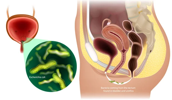 女性の尿路感染症 膀胱と尿道にある直腸から細菌が来る 細菌性膀胱炎 大腸菌 — ストックベクタ