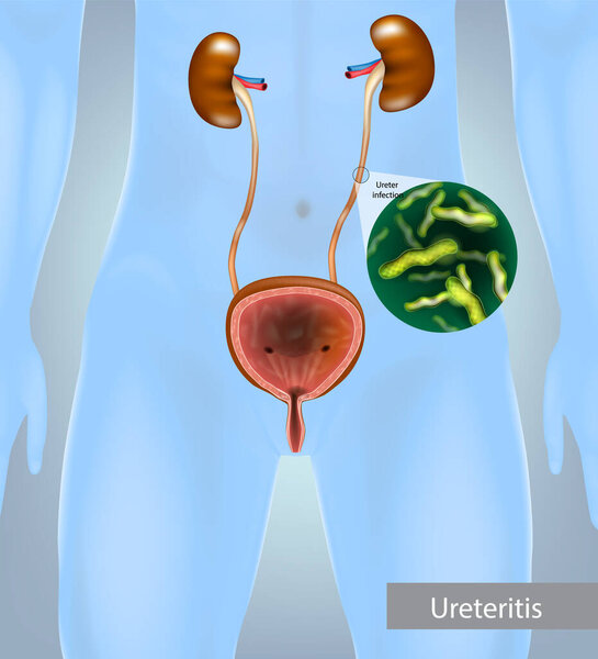 Ureteritis. Inflammation of the ureter. Ureter infection