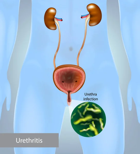Urethritis Húgycső Gyulladása Húgyúti Fertőzés Gonococcus Húgyúti Gyulladás — Stock Vector