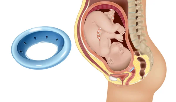 자궁경부를 임산부의 Preterm 출생의 위험에 여성에서 비정상의 효과적인 위치의 모델링 — 스톡 벡터