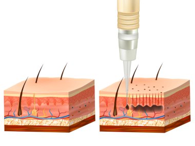 Dövme Süreci 'nin insan derisinin katmanlarının kesiti. Kalıcı makyaj prosedürü. Epidermis ve Derinin altında Pigment.
