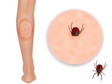 Lyme disease or Lyme borreliosis, is a disease caused by Borrelia bacteria. Erythema migrans. Vector clipart