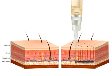 Dövme İşlemi. Epidermis ve Derinin altında Dövme Pigment.