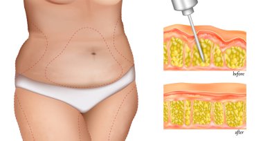 Bir kadında liposuction müdahalesinin resmi. Yağ aldırma prosedürü ya da yağ aldırma. Estetik ameliyat tekniği.