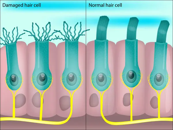 コクリーの中の健康で損傷した髪の細胞 騒音による聴力損失 ティナトス — ストックベクタ