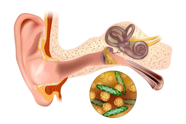 细菌性耳炎 耳朵感染中耳 肺炎链球菌和流感嗜血杆菌链球菌 — 图库矢量图片