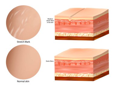 Medical Anatomy Skin Stretch Marks. Collagen elastin. Normal skin and Stretch Mark clipart