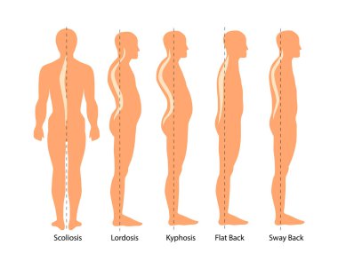 Omurilik bozukluğunun tıbbi örnekleri: skolyoz, lordosis ve kifoz, geriye doğru sallanma. Vücut duruşu kusuru. Omurga hastalıklarının bilgileri.