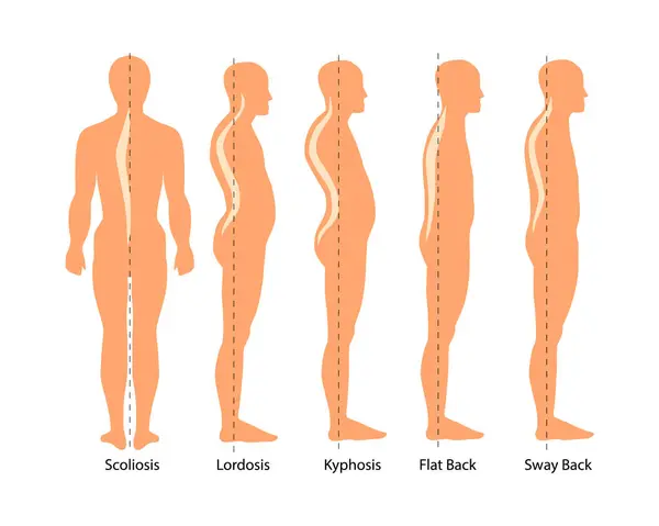 脊髄変形タイプの医学的イラスト 脊柱症 スウェイバック 体の姿勢の欠陥について 脊椎疾患のインフォグラフィック — ストックベクタ