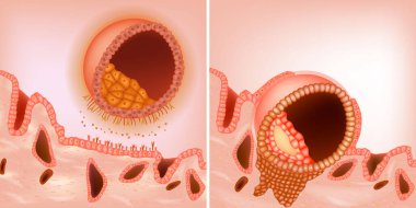 The process during the embryo implantation. The blastocyst implants to the maternal endometrium. Blastocyst. Apposition and Adhesion clipart