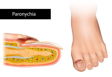 Paronychia is an inflammation of the skin around the nail. Nail Infection clipart