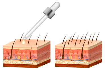 Alopecia vitamin kılı tedavisi. Tedavi öncesi ve sonrası kafa derisindeki saç sayısı.