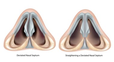 Deviated nasal septum and Straightening a Deviated Nasal Septum. Septoplasty and Rhinoplasty clipart