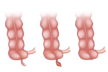 Apandisit apandisitin iltihaplanmasıdır. Apandisin iltihaplanması. Apandisit Tedavi Cerrahisi. Apandisit ameliyatı. Laparoskopik Ek Silme