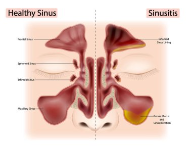 Sağlıklı Sinüs ve Sinüzit veya Rhinosinusit. Aşırı Sümük ve Sinüs Enfeksiyonu