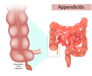 Apandisit apandisitin iltihaplanmasıdır. Apandisit Tedavi Cerrahisi. Apandisit ameliyatı.