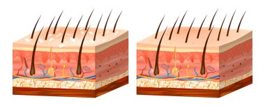 Seborotik ya da Seborrheic dermatitis. Tedavi öncesi ve sonrası. Genelde kafa derisini etkileyen kronik ya da nükseden deri iltihabı.