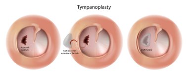 Tympanoplasty Surgery Operation. Reconstruct hearing mechanism of middle ear. Ruptured eardrum clipart