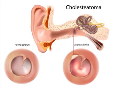Kolesteatom ve normal kulak zarı. Retraksiyon ve delinmiş kulak zarı. Otorhinolarengoloji İnsan kulak anatomisi