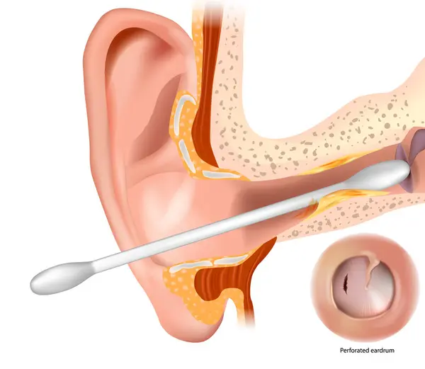 stock vector Cotton swabs a major cause of eardrum perforations. Risks of Using Cotton Buds for Ear Cleaning. Burst or perforated eardrum