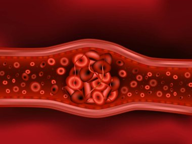 Emboli. Kopmuş trombusun damar tıkanıklığını tasvir eden bir resim. Kan pıhtılaşması ya da pıhtılaşmış eritrositli trombüs..