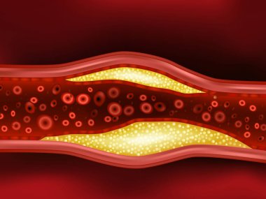 Arterde kolesterol plağı var. Ateroskleroz. Atardamar Plağı