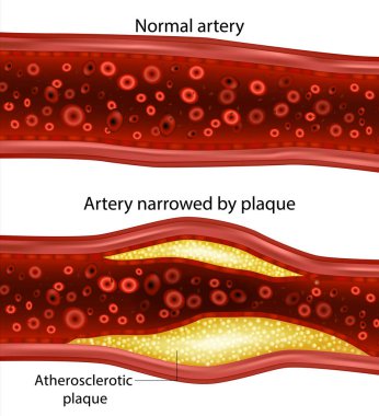 Arter plakla ve normal arterle daraldı. Atherosklerotik plaket. Atardamarda kolesterol plağı var.