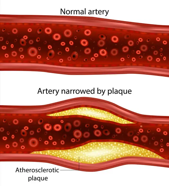 stock vector Artery narrowed by plaque and Normal artery. Atherosclerotic plaque. Cholesterol plaque in artery