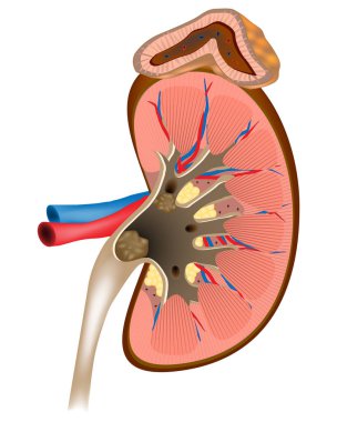 Böbrek taşı hastalığı. Böbrek kalkülüs hastalığı, nephrolithiasis veya urolithiasis. Böbrek kalkülüsünün idrar yolunda geliştiği kristalopati.
