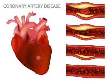 Koroner arter hastalığı ve iskemik kalp hastalığı. Koroner arterde damar tıkanıklığı. Kardiyovasküler hastalıklar. Kalp kasına giden kan akışının azalması..