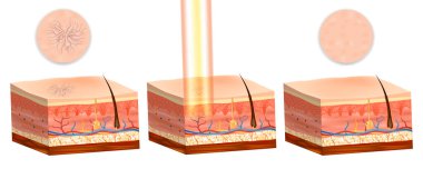 Telangiectasia ve retiküler damarlar için lazer tedavisi. Tedavi öncesi ve sonrası