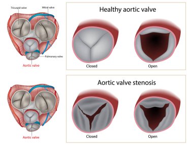 Aort kapakçığı stenozu ve sağlıklı aort kapakçığı. Kalp kapakçığı hastalığı. Anatomi kalbi
