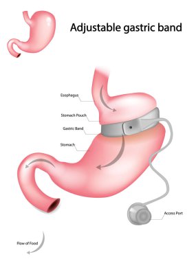 Ayarlanabilir Gastrik Bandın İllüstrasyonu. Laparoskopik mide bandı.