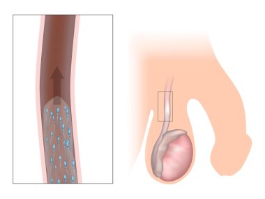 İnsan Erkek Üreme Sistemi - Spermatik Kanal Anatomisi. Erkek Üreme Kanallarında Sperm Hareketi. Erkek Spermatik Kanalı 'nın kesiti