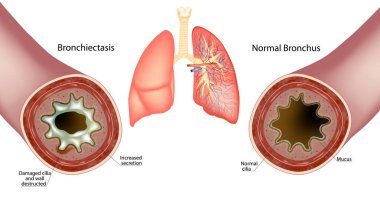 Bronşiectasis ve Normal Bronchus. Artan salgı sümüğü. Duvar yıkıldı ve hasarlı silia Bronchus