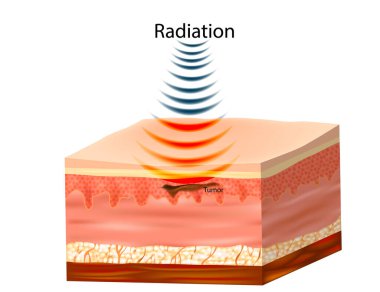 Radyasyon terapisi ya da radyoterapi. Kanser tedavisi, kanser hücrelerini ve tümörleri öldürmek için yüksek dozda radyasyon kullanıyor. Stereotaktik Vücut Radyoterapisi